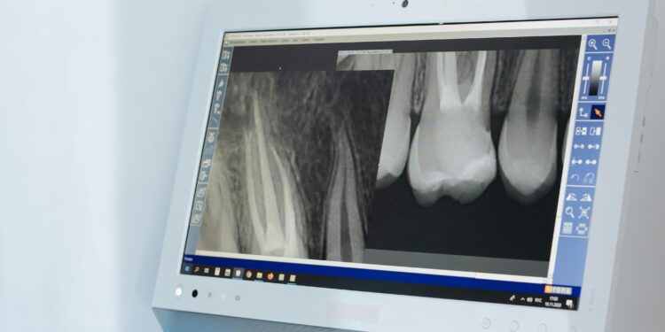 Diagnosis and Treatment of Cancer Spread To Bone (Bone Metastasis)