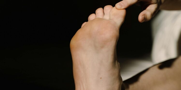 Gout Pain: Causes, and Symptoms