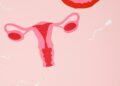 Risk of Getting Ovarian Torsion, How to Identify and Treat Ovarian Torsion: A Comprehensive Guide