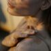 Life With Vitiligo: How To Navigate, and Treatment Options