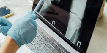 Bone Metastasis: Symptoms, Types and Causes