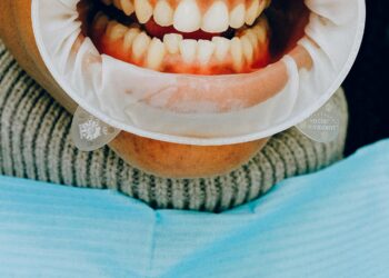 “Why Do I Have Bleeding Gum?” Common Causes Explained