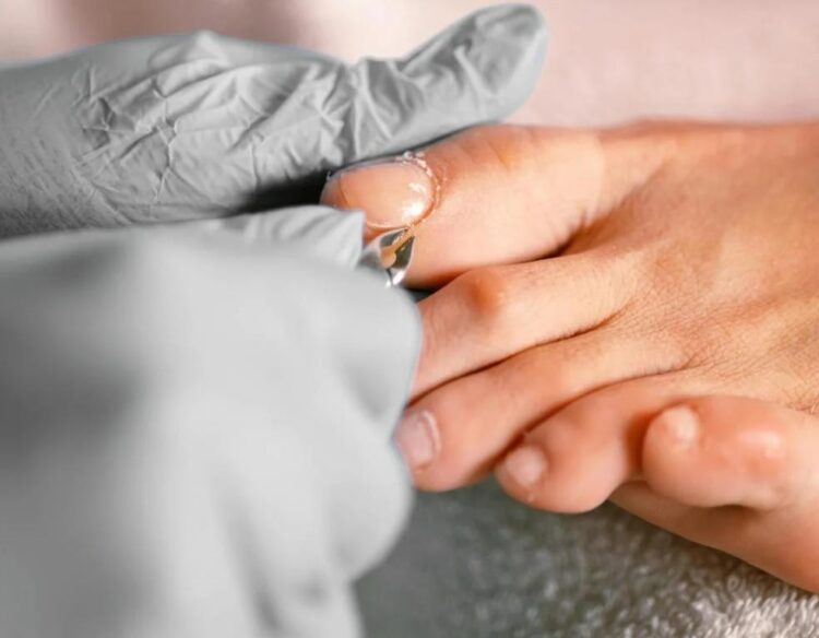 Ingrown Toenail: Symptoms, Causes, and Complications