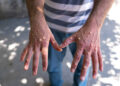 Africa Faces Unchecked Mpox Surge