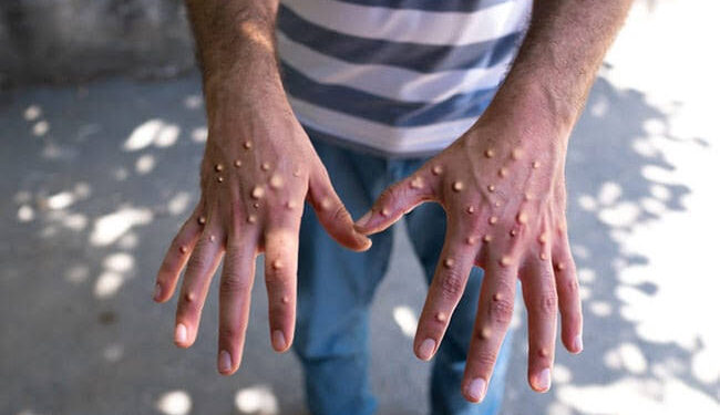 Africa Faces Unchecked Mpox Surge