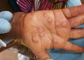 Congo’s Mpox Crisis: Patients Suffer as Government Drags Its Feet