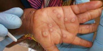Congo’s Mpox Crisis: Patients Suffer as Government Drags Its Feet