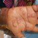 Congo’s Mpox Crisis: Patients Suffer as Government Drags Its Feet