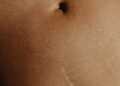 Umbilical Hernia: Types, Symptoms, and Causes