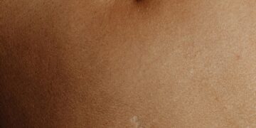 Umbilical Hernia: Types, Symptoms, and Causes