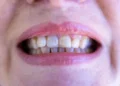 Wisdom Teeth: Anatomy, Function, Symptoms and Causes of Wisdom Teeth Problems