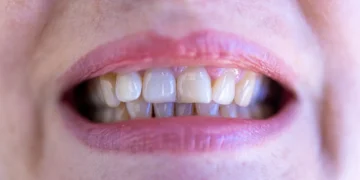 Wisdom Teeth: Anatomy, Function, Symptoms and Causes of Wisdom Teeth Problems