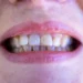 Wisdom Teeth: Anatomy, Function, Symptoms and Causes of Wisdom Teeth Problems