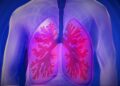 Lung Abscess: What It Is, Symptoms, Historical Prevalence, and Causes