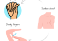 Marfan Syndrome: Causes, Symptoms, and Occurrence