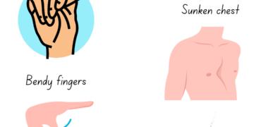 Marfan Syndrome: Causes, Symptoms, and Occurrence