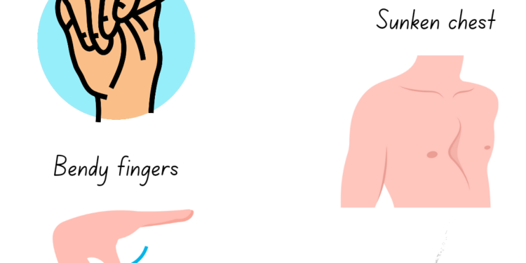 Marfan Syndrome: Causes, Symptoms, and Occurrence