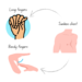 Marfan Syndrome: Causes, Symptoms, and Occurrence