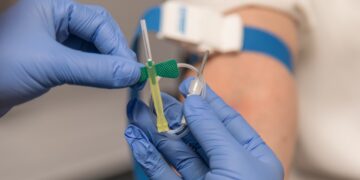 Vein Dilation: Causes, and Symptoms