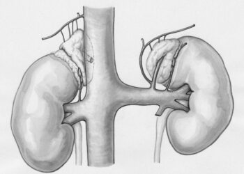 Polycystic Kidney Disease: Types, Symptoms, Complications, and Causes
