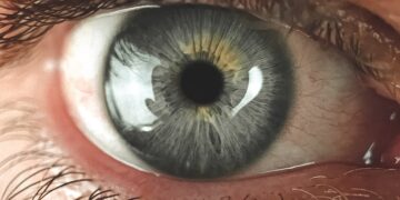 Corneal Abrasion: Function of the Cornea, Symptoms, and Causes of Corneal Abrasion