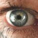 Corneal Abrasion: Function of the Cornea, Symptoms, and Causes of Corneal Abrasion
