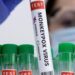 UK Confirms First Case of Highly Contagious Mpox Strain