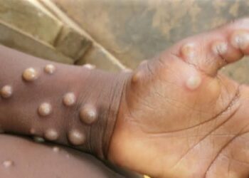 Africa’s Mpox Crisis: Over 800 Dead as Epidemic Spirals Out of Control
