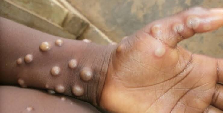 Africa’s Mpox Crisis: Over 800 Dead as Epidemic Spirals Out of Control