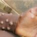 Africa’s Mpox Crisis: Over 800 Dead as Epidemic Spirals Out of Control