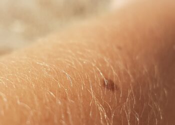 Know Your Skin: Primary Skin Lesions vs. Secondary Skin Lesions