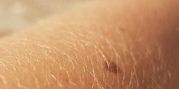 Know Your Skin: Primary Skin Lesions vs. Secondary Skin Lesions