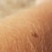 Know Your Skin: Primary Skin Lesions vs. Secondary Skin Lesions