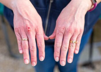 Bedsores (Pressure Sores): Stages and Causes 