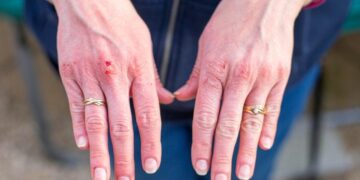 Bedsores (Pressure Sores): Stages and Causes 