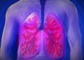 Acute Respiratory Distress Syndrome (ARDS): Process, Symptoms, and Causes