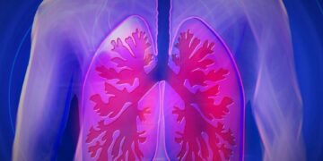 Acute Respiratory Distress Syndrome (ARDS): Process, Symptoms, and Causes