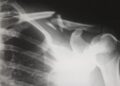 Frozen Shoulder: Stages, Symptoms, and Causes