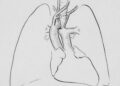 Effective Treatment Methods for Acute Respiratory Distress Syndrome (ARDS)