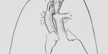 Effective Treatment Methods for Acute Respiratory Distress Syndrome (ARDS)