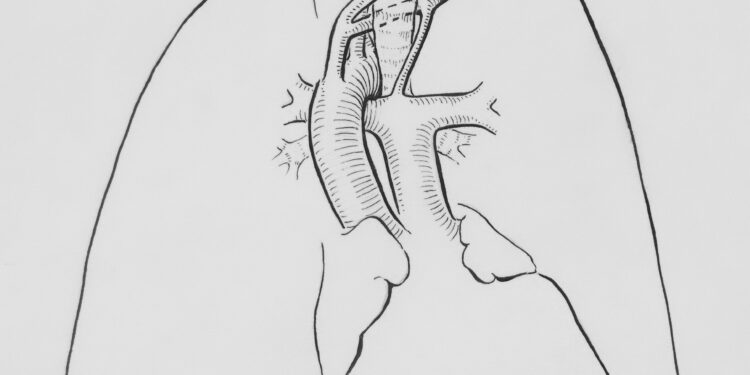 Effective Treatment Methods for Acute Respiratory Distress Syndrome (ARDS)