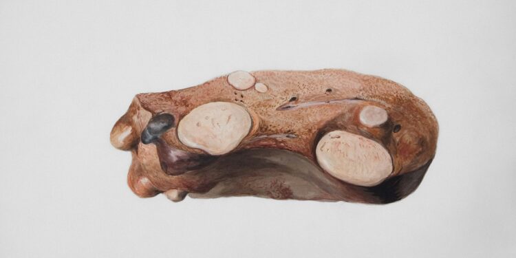 Fatty Liver Disease: Types, Symptoms, and Risk Factors