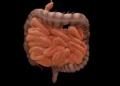 Diverticulitis: Process, Symptoms, Causes, and Complications