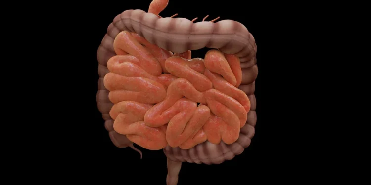 Diverticulitis: Process, Symptoms, Causes, and Complications 