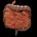 Diverticulitis: Process, Symptoms, Causes, and Complications