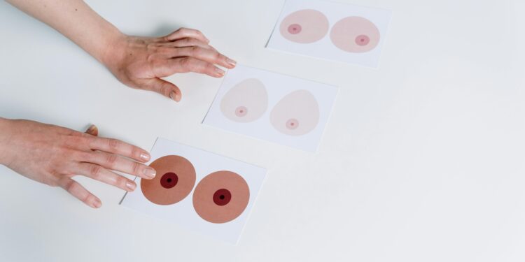 Not All Breast Pain is Breast Cancer, It Could Be Mastalgia 