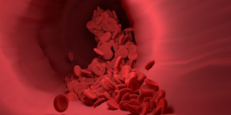 Aneurysm: Types, Symptoms and Causes