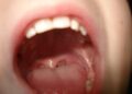 Glossitis: Process, Symptoms, Causes, and Types