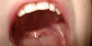 Glossitis: Process, Symptoms, Causes, and Types 