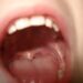 Glossitis: Process, Symptoms, Causes, and Types